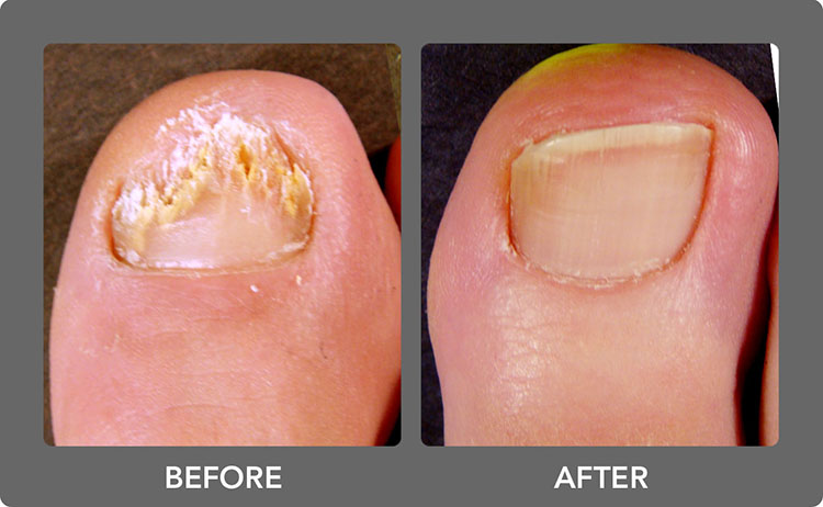nail fungus before and after
